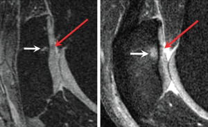 OA knee Figure 1