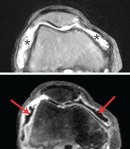 OA knee Figure 2