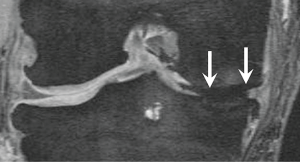 OA knee Figure 3