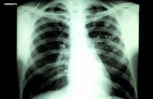 Tuberculosis X-ray