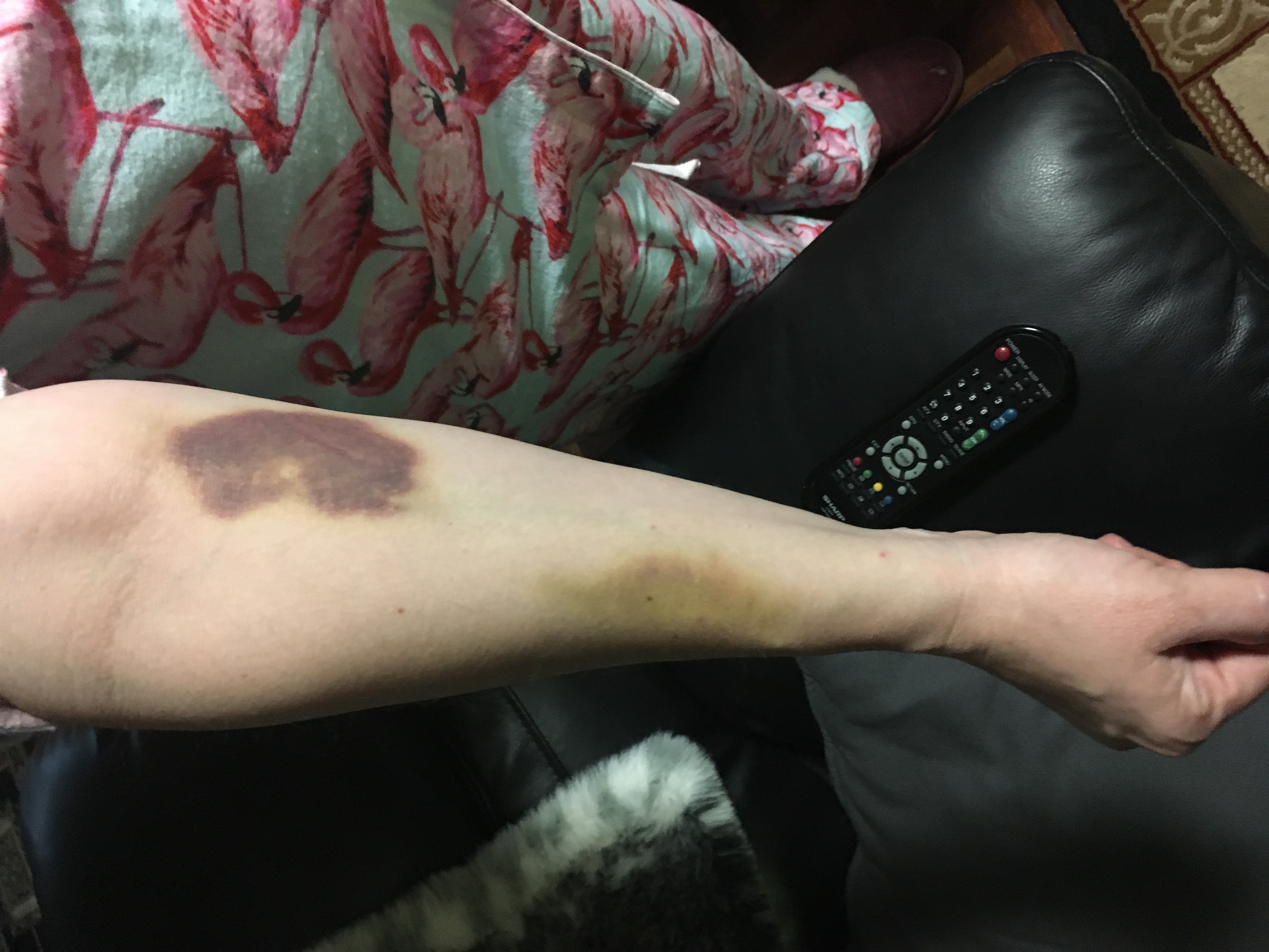 The result of two collapsed veins during IV insertion, 10 days later