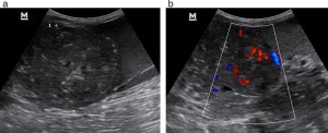 FIG 1: Sagittal transabdominal ultrasound images of the thorn-induced granuloma. (a) The granuloma is seen between the measured callipers with the echogenic exudate caudal to the mass. (b) Image slightly more medially. Colour flow Doppler illustrates the vascularity of the mass 